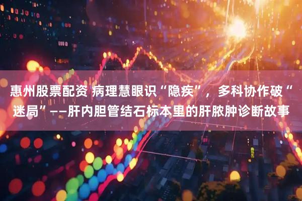 惠州股票配资 病理慧眼识“隐疾”，多科协作破“迷局”——肝内胆管结石标本里的肝脓肿诊断故事